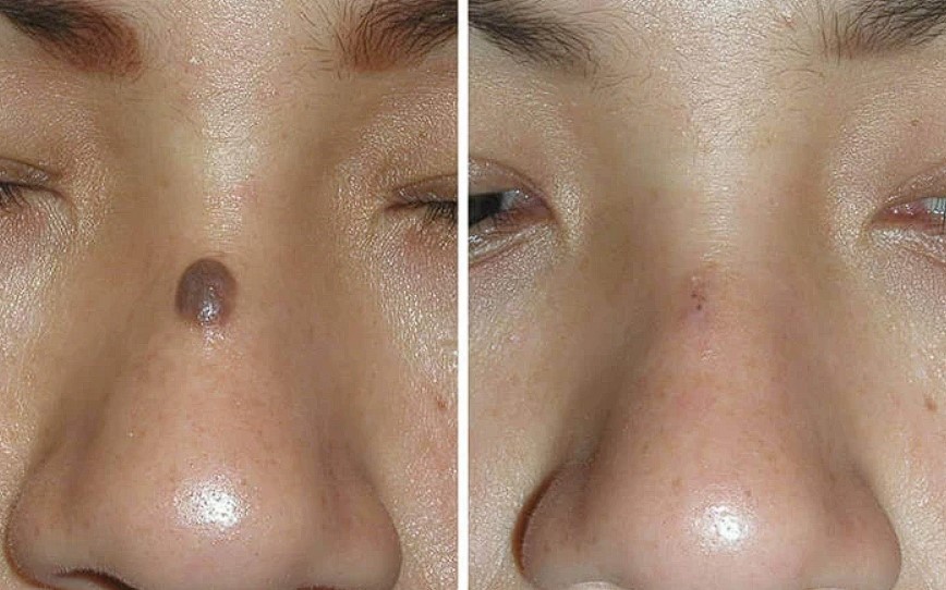 Extracción de Lunares, En Cuerpo y Rostro.